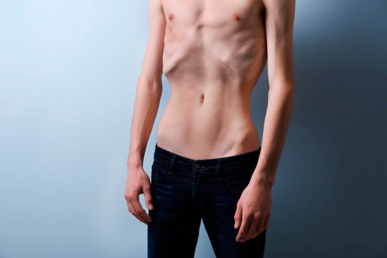 Anorexia
